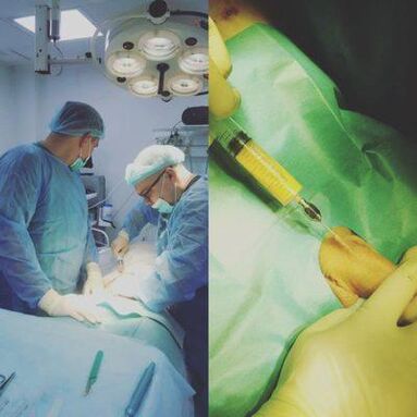 Thickening of the penis is possible with the help of surgery